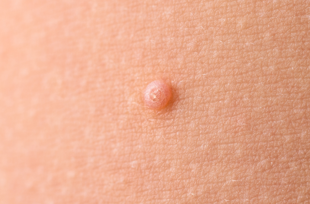 Molluscum contagiosum, ¿qué es?