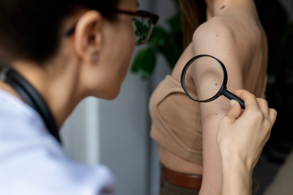Claves en el seguimiento de los lunares o nevus melanocíticos